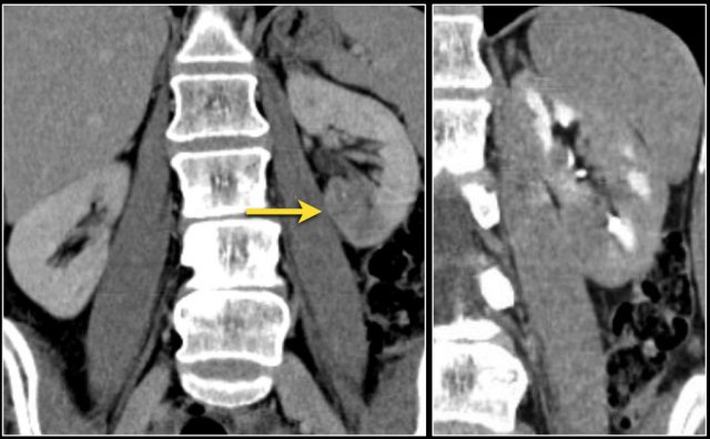 TCC in left kidney preserving the bean shape of the kidney