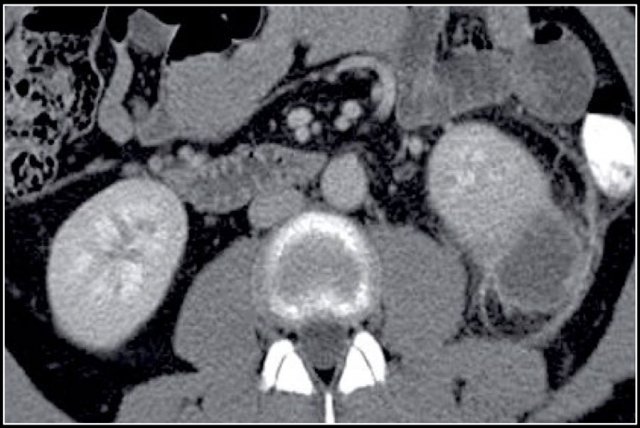 Cystic lesion with thick enhancing rim and infiltration of perirenal fat in a patient with a renal abscess