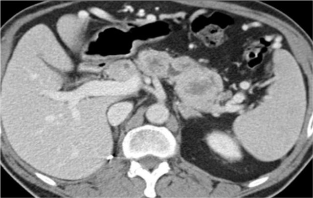 Metastases of RCC in the pancreas.