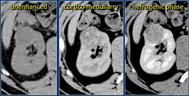 Clear cell carcinoma best seen in nefrogenic phase