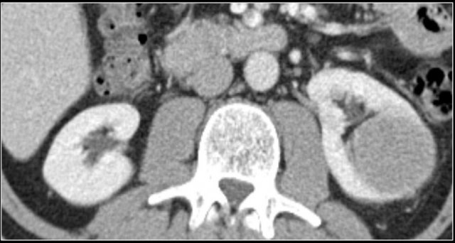 Chromophobe RCC