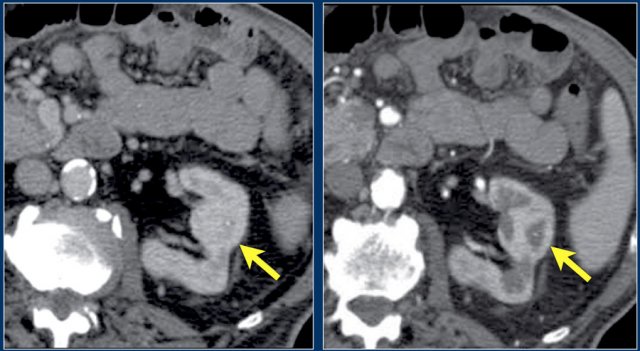 Pseudotumor. Nefrogenic phase on the left and corticomedullary phase on the right.