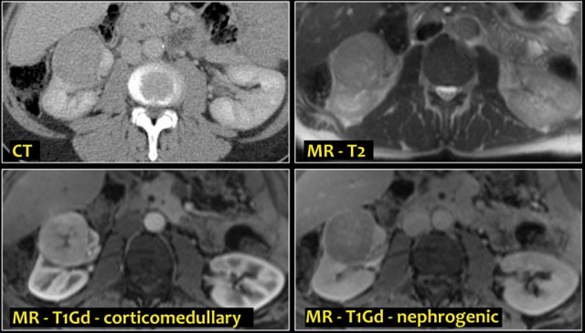 Oncocytoma in right kidney with central scar