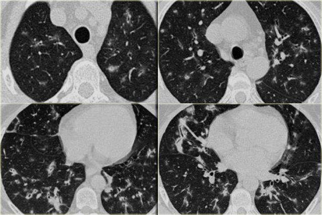 OP in a patient with collagen vascular disease