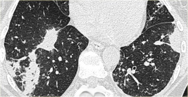 OP in rheumatoid arthritis