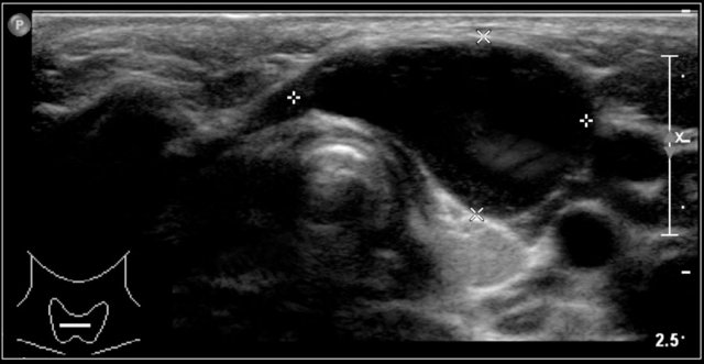 Thyroglossal duct cyst