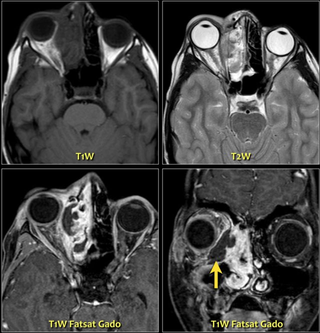 Periorbital abscess