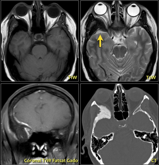 Meningioma with hyperostosis of sphenoid wing and proptosis