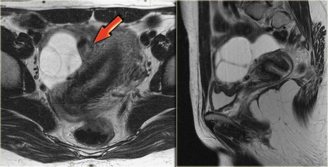 Hemorrhagic ovarian cyst