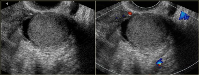 Endometrioma