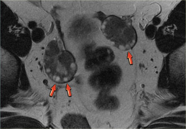 Axial MR demonstrating characteristic 'string-of-pearls' appearance