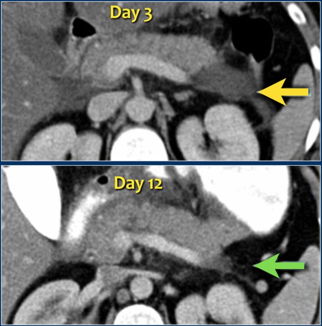 Spontaneous regression of APFC.