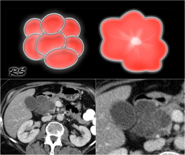 Figure 14. Serous cystic adenomas contain multiple small cysts resulting in a lobulated contour. Some have a central scar with calcifications.