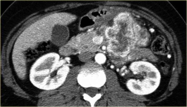 Neuroendocrine tumor with central necrosis