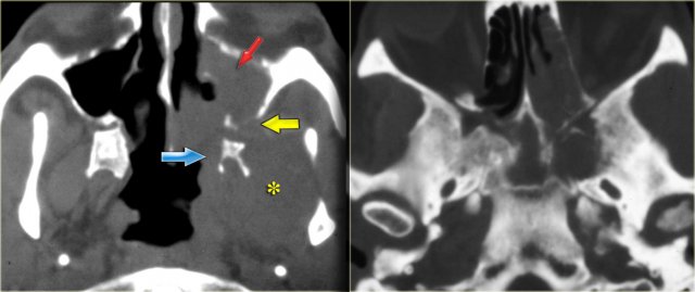 Lymphoma of sphenoid sinus and skull base