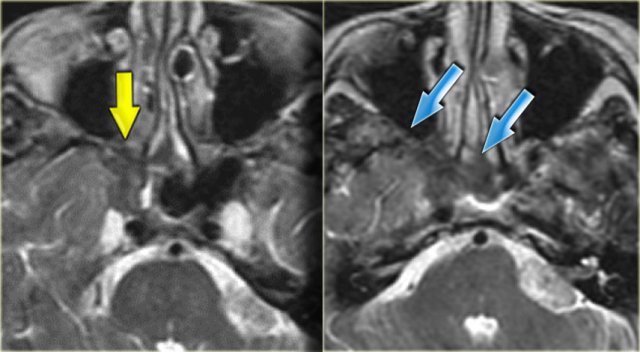 Sinonasal carcinoma