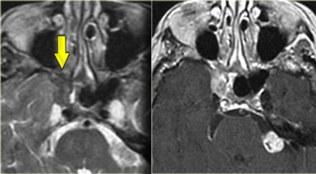 Sinonasal carcinoma