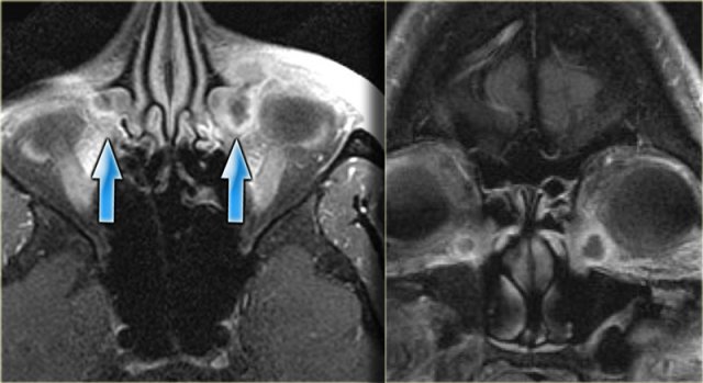 Orbital cellulitis and abscess