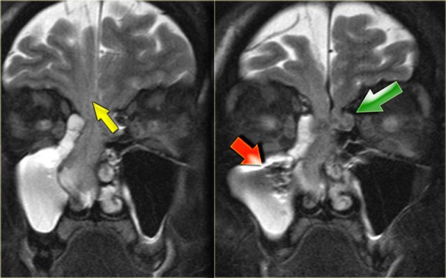 Encephalocele