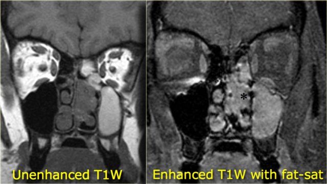 Inverted papilloma (asterix) pre- and postcontrast MR