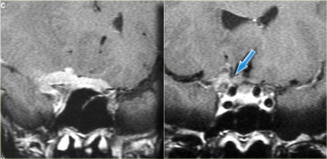 Meningioma