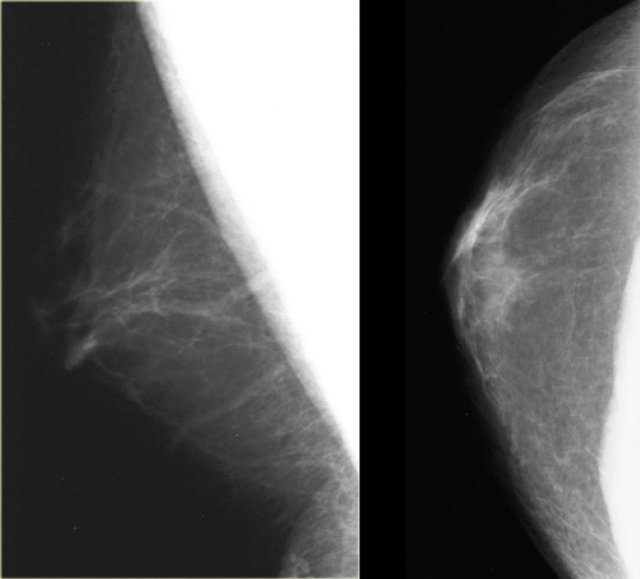 Normal male mammogram