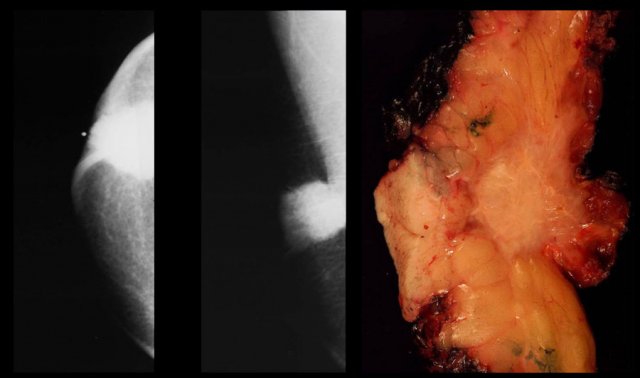 Invasive ductal carcinoma