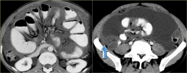 Mucinous Carcinomatosis with a tumor nodule along the right paracolic gutter