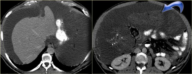 Pseudomyxoma peritonei with thickened mesentery (arrow)