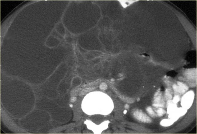 Lymphangioma