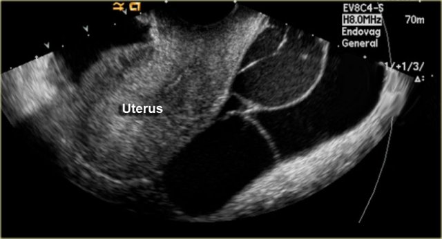 Peritoneal Inclusion Cyst