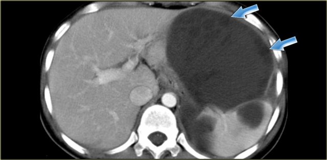 Echinococcal cyst with daughter cysts (arrows)