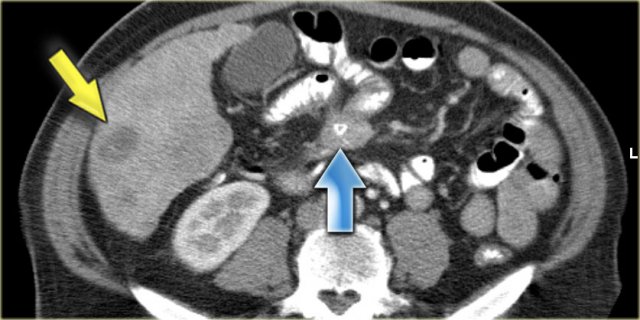 Carcinoid