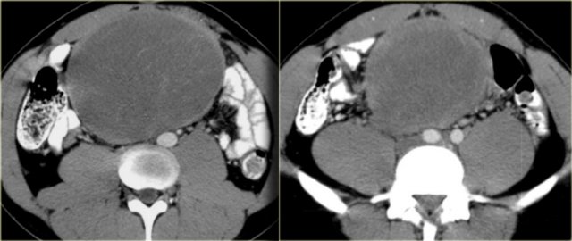 Mesenteric fibromatosis