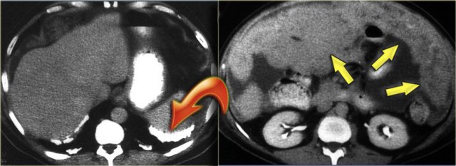 Malignant mesothelioma