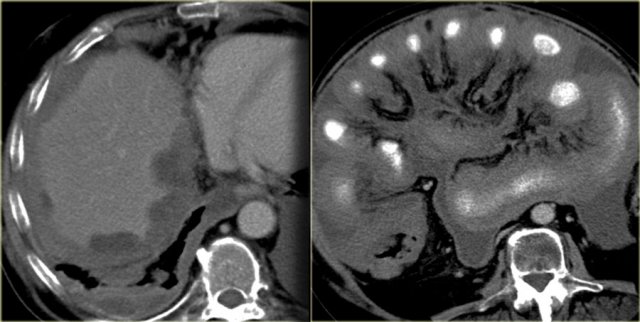 Malignant mesothelioma