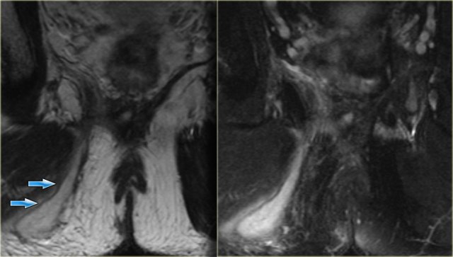 Perianal abscess