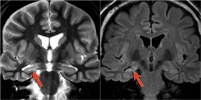 Right-sided mesial temporal sclerosis