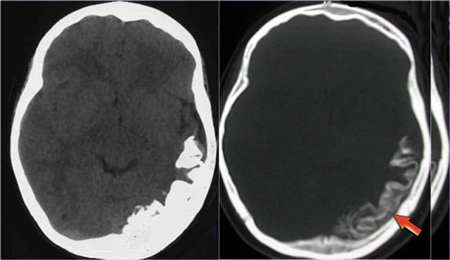 Sturge-Weber angiomatosis. Courtesy of Alessandra D' Amico