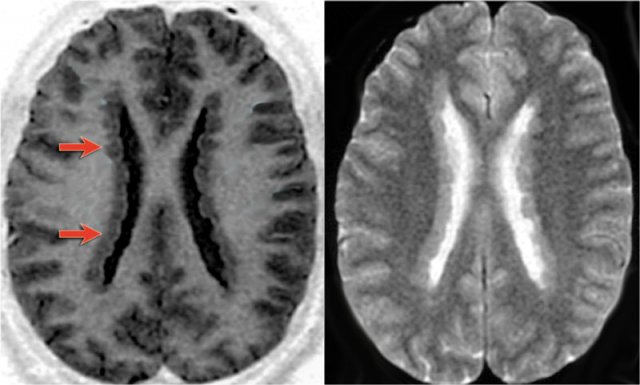 Heterotopia: subependymal nodules (arrows).