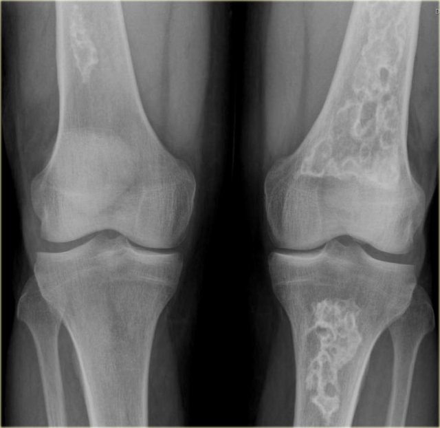 Multiple bone infarcts