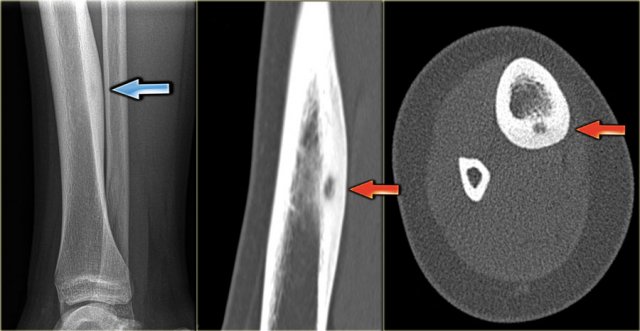 Osteoid osteoma