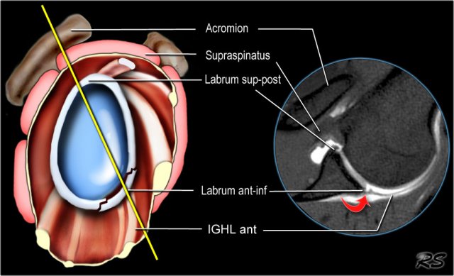 ABER-view. Perthes lesion (arrow)