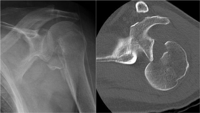 Posterior dislocation-fracture