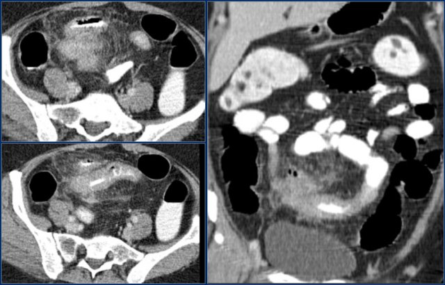 Adenocarcinoma in Crohn's disease