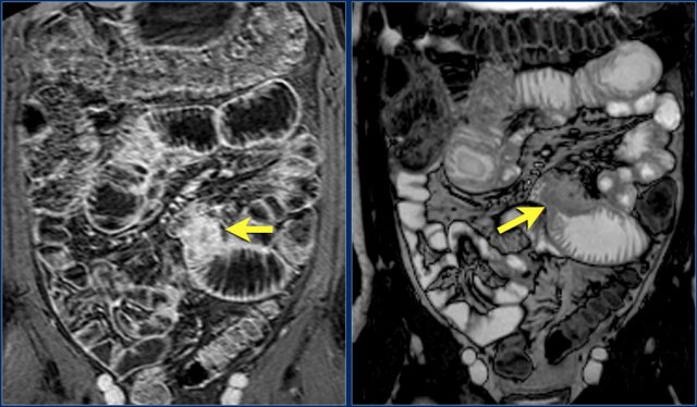 Adenocarcinoma in the jejunum