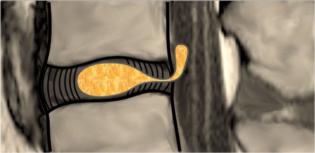 Migration of herniated disc material