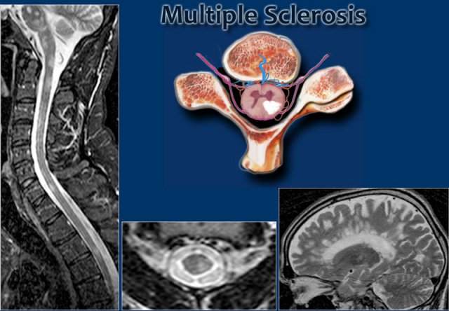 MS: short segment focal wedge-shaped involvement of the posterior column of the spinal cord with typical periventricular WM-lesions.