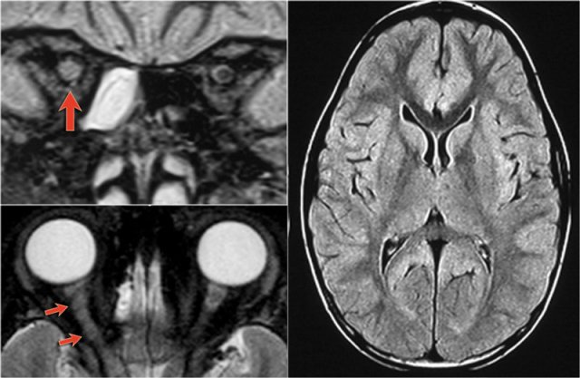 NMO presenting with neuritis optica (arrows). The brain is normal.Courtesy Andrea Rossi