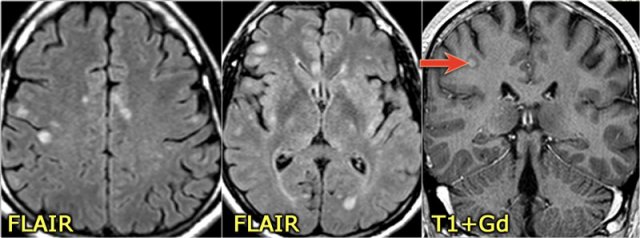 Idiopathic Vasculitis